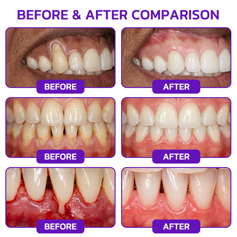 🦷JOUS® VioCore ✨ Bee Venom Gingivitis & Periodontitis Treatment Toothpaste